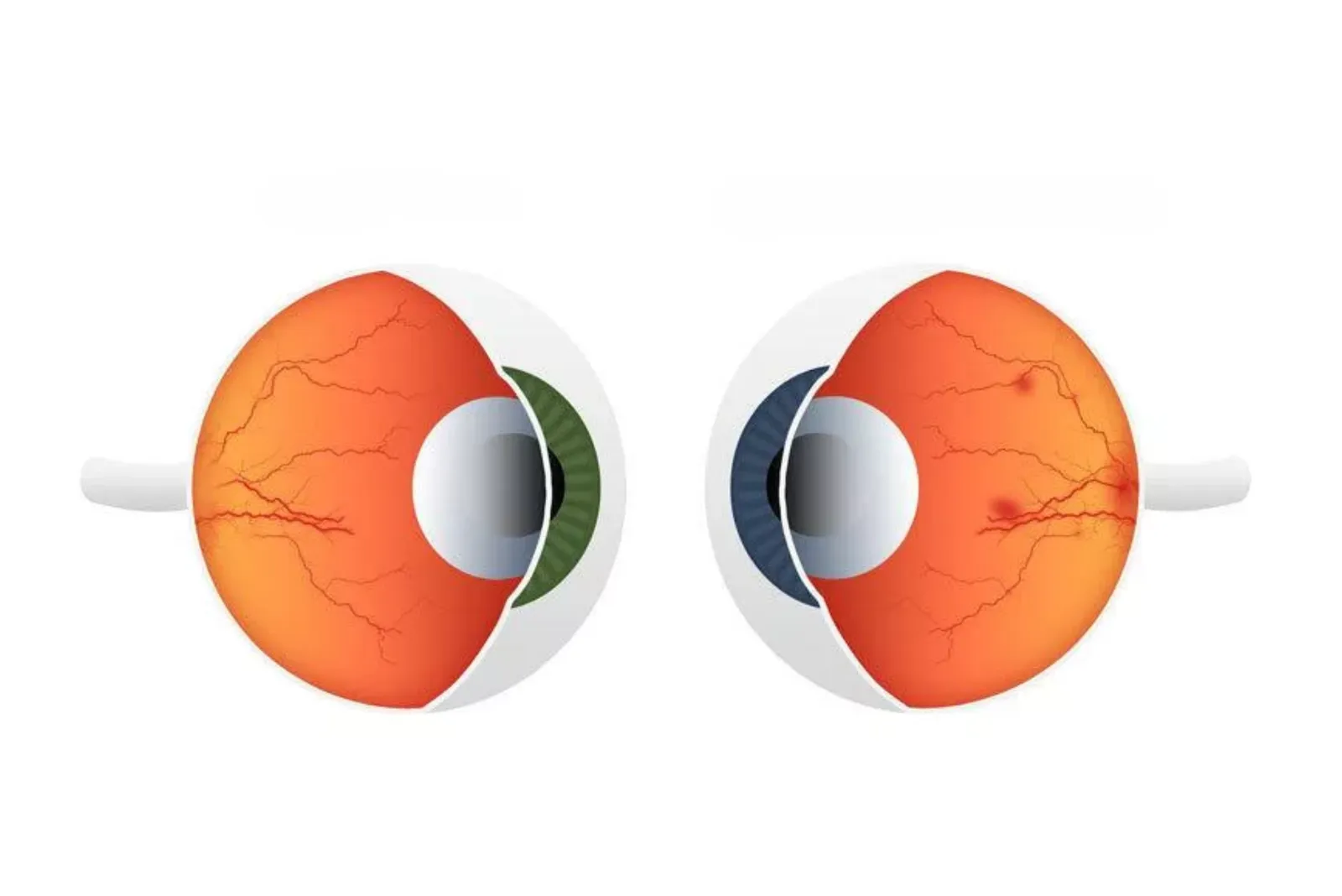 Diabetic eye care and retinopathy screening at Sarojana Eye Hospital, Hasthinapuram, Hyderabad