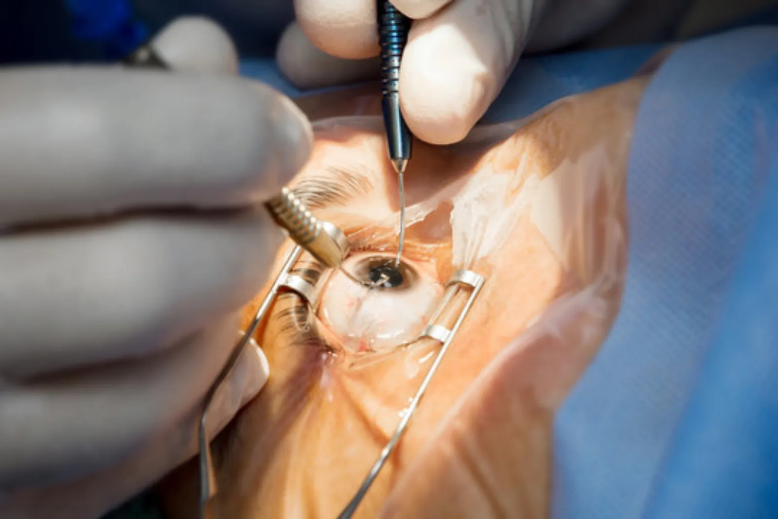 Phacoemulsification and sutureless IOL cataract surgery at Sarojana Eye Hospital, Hasthinapuram, Hyderabad